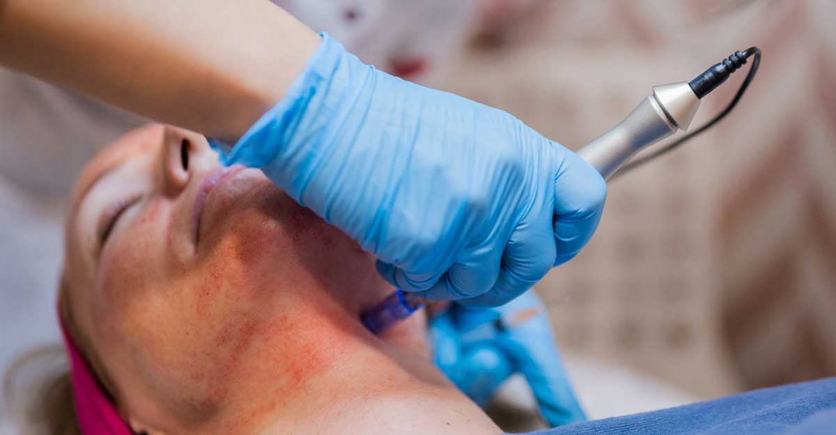 Benefits of Microneedling
