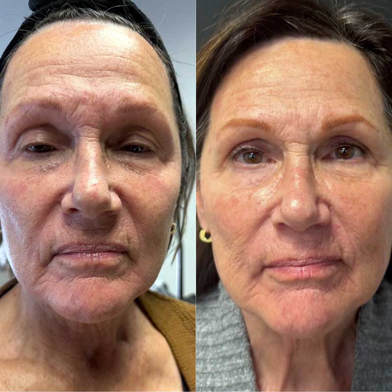 Before and after Nouvaderm Before and after Nouvaderm
