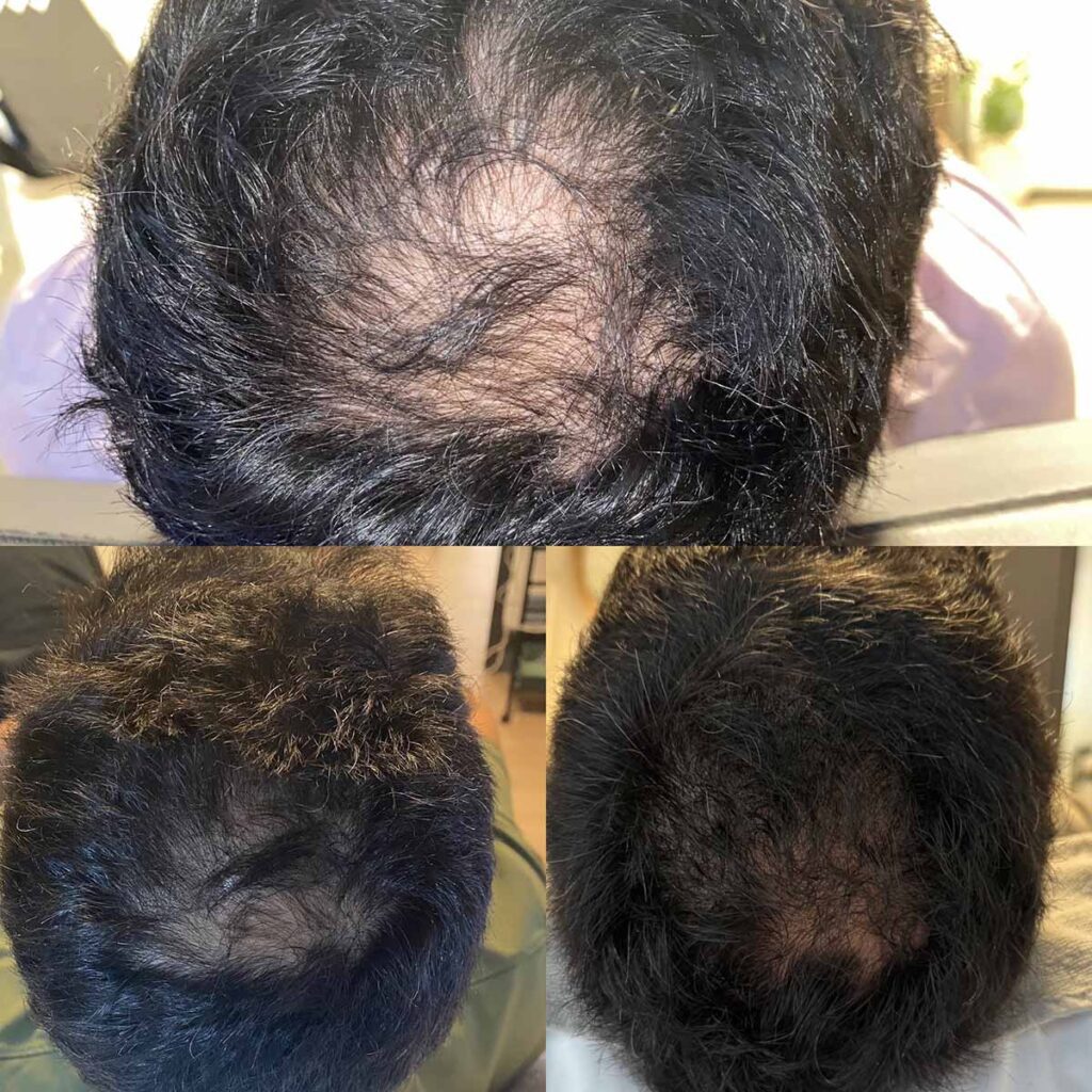 Keravive Scalp Treatment