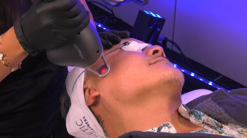 NOUVADerm laser treatment