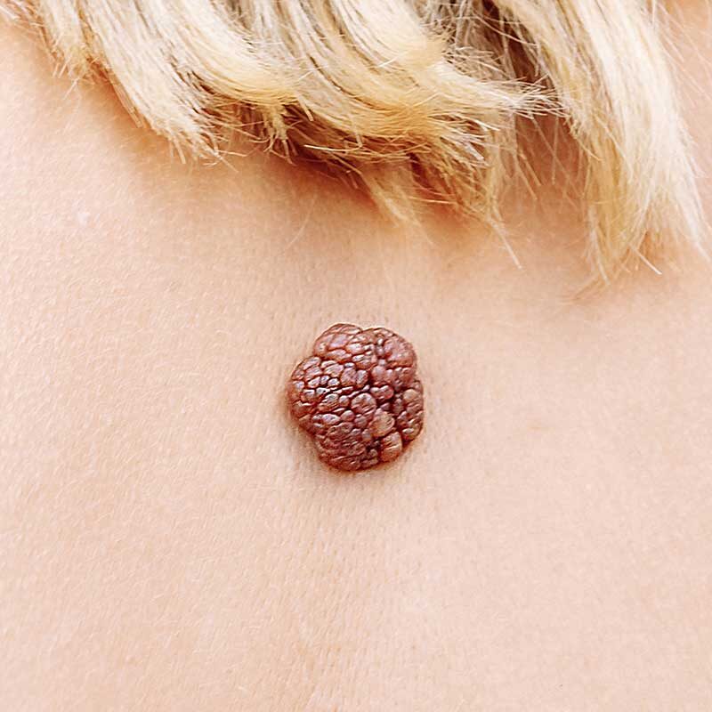 Skin Cancer Prevention