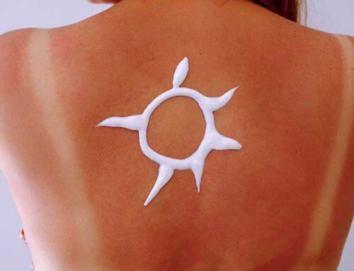 Sun-Kissed or Sun-Stressed?