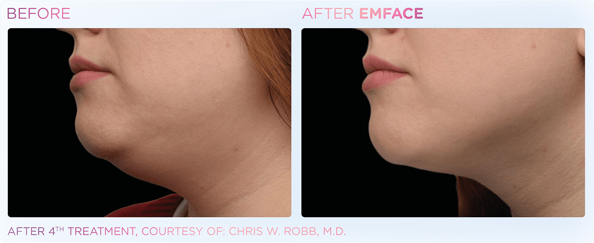 emface before and after