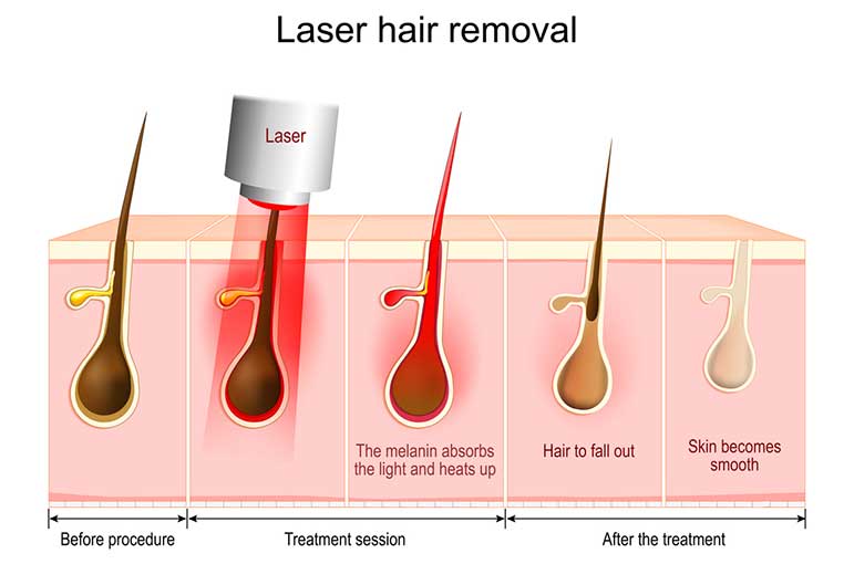 laser hair removal