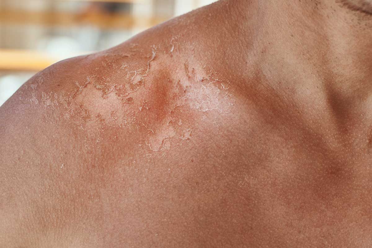 sunburn on the shoulders sunburn on the shoulders