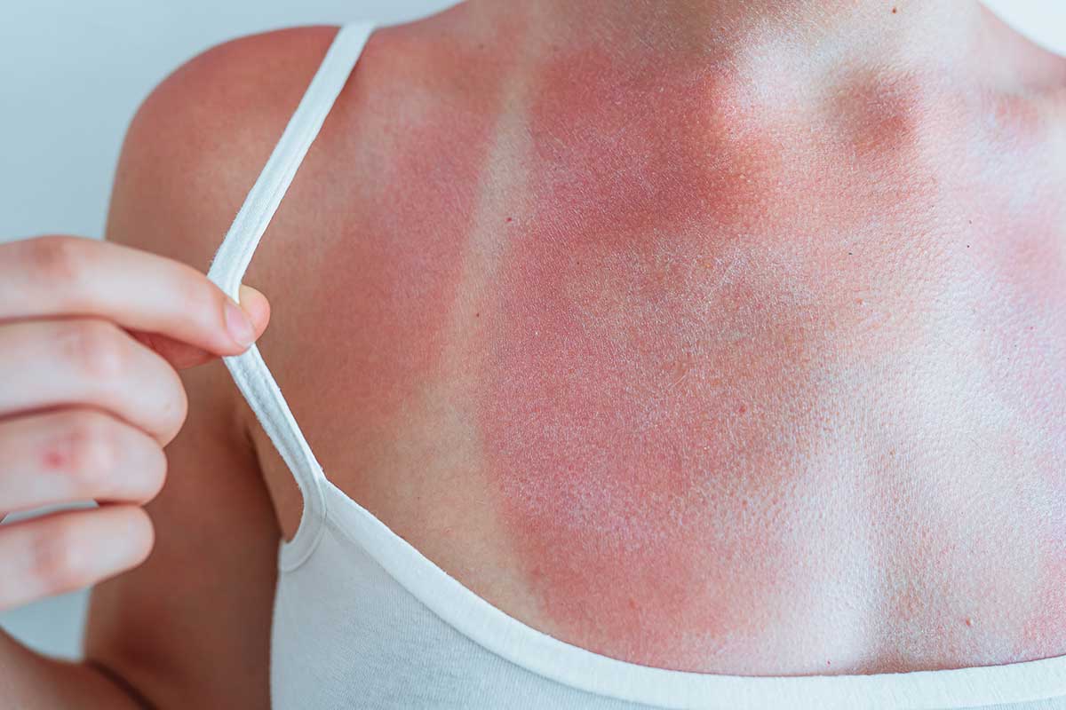 woman’s chest with bad sunburn